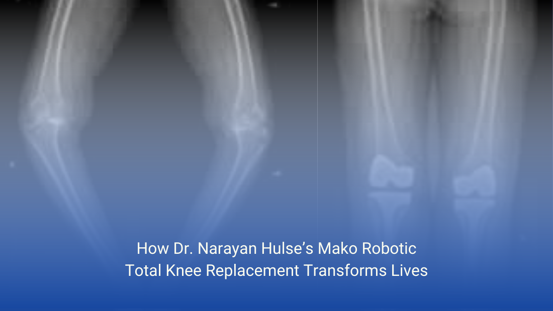How Dr. Narayan Hulse’s Mako Robotic Total Knee Replacement Transforms Lives