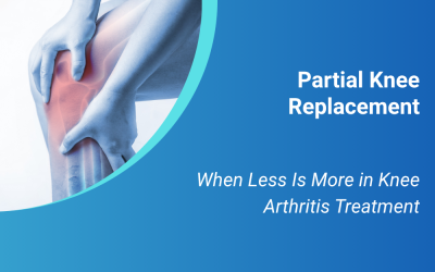 Partial Knee Replacement: When Less Is More in Knee Arthritis Treatment