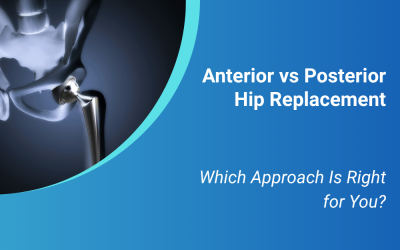 Anterior vs Posterior Hip Replacement: Which Approach Is Right for You?