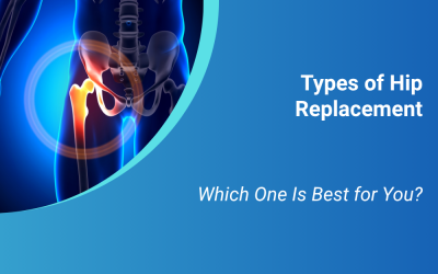 Types of Hip Replacement: Which One Is Best for You?